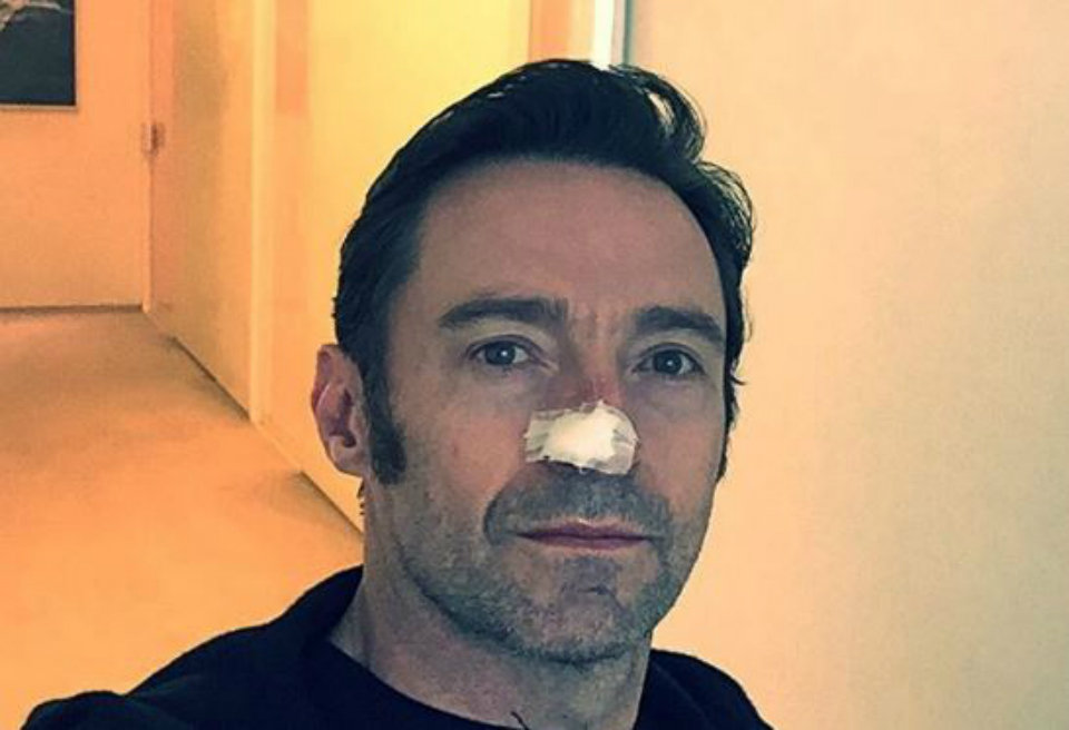Qué es el carcinoma basocelular, el cáncer de piel que sufre el actor Hugh Jackman