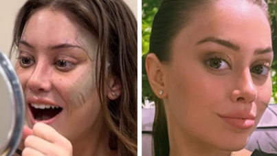 ¿Un “lifting” a los 28? Por qué cada vez hay más jóvenes que recurren a la cirugía plástica