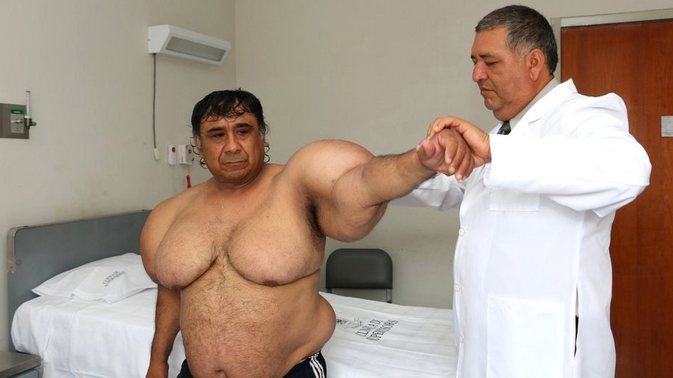 “La gente se para a mirarme como a un animal raro”, el extraño caso del buzo peruano que tiene el cuerpo “inflado” desde hace cuatro años