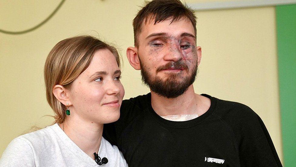 “Se necesita una nueva definición de belleza en Ucrania”: el creciente número de amputados en la guerra contra Rusia