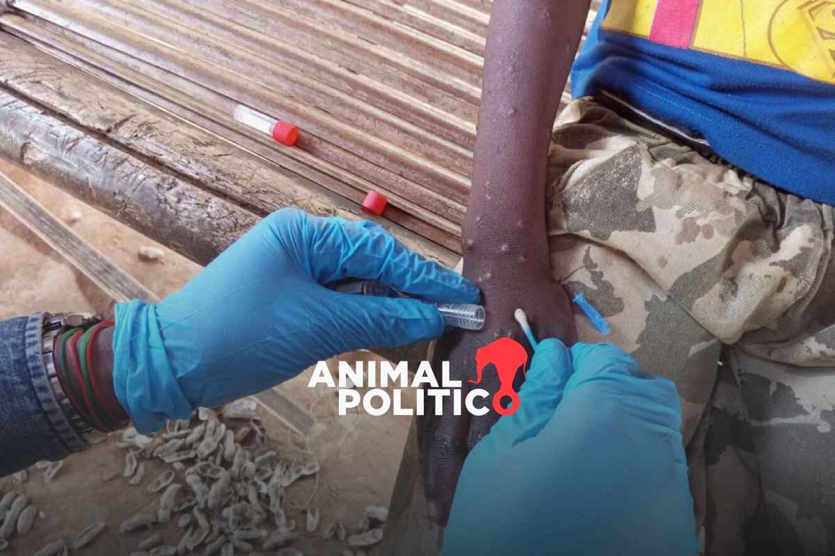 Registran nuevo caso de Mpox en México; la OMS mantiene alerta por la epidemia mundial