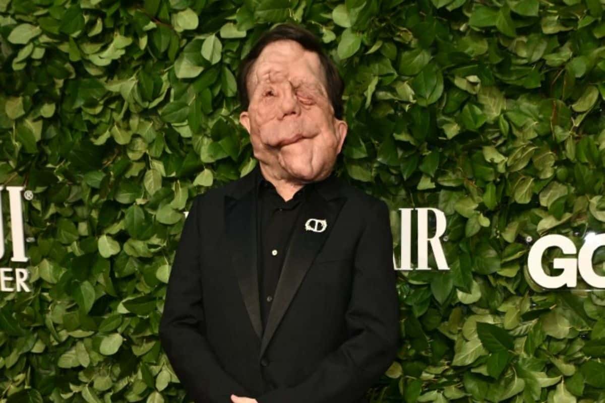 Actor y activista: Conoce a Adam Pearson, el actor de 'Un hombre diferente' con neurofibromatosis