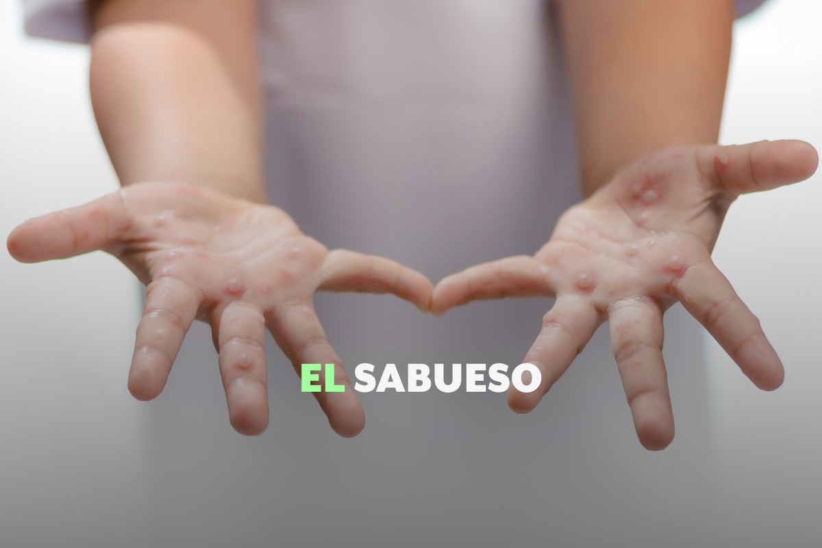 ¿Qué es la enfermedad de manos, pies y boca? Mitos y recomendaciones