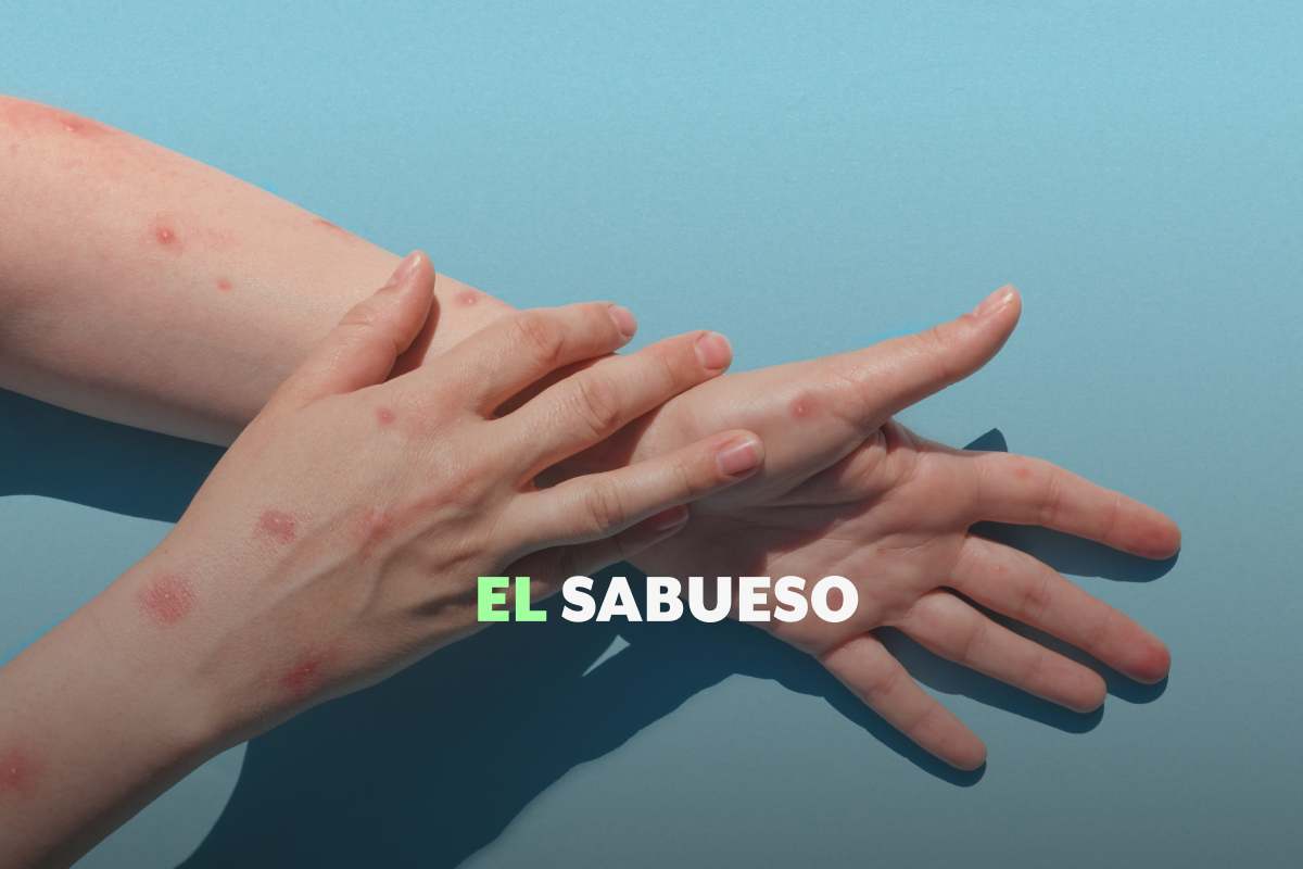 Sarampión: ¿qué debes hacer si te contagias y cómo evitar complicaciones?